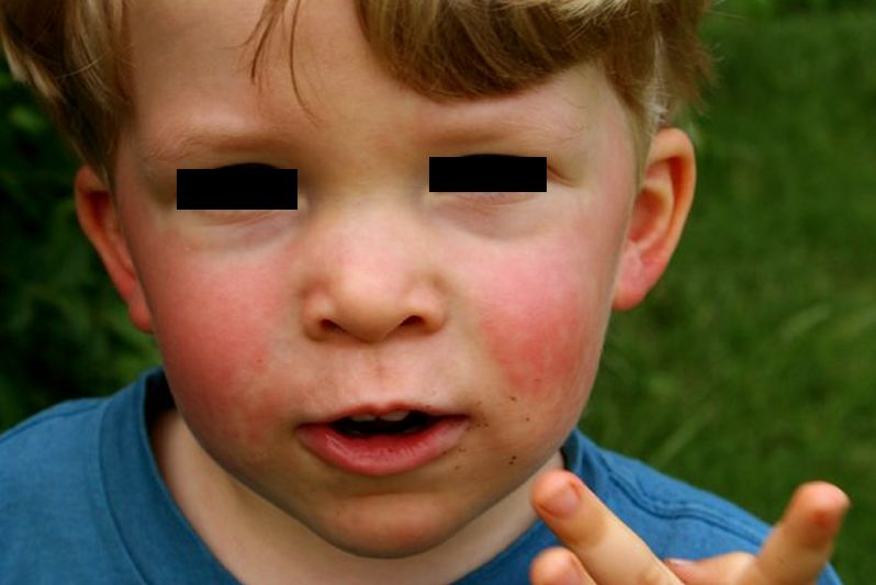 Rash and Fever - check medical symptoms at RightDiagnosis