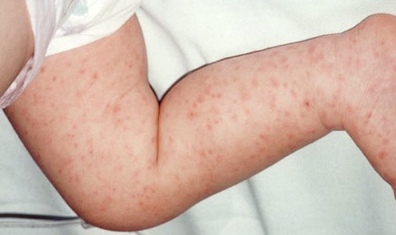 Meningitis: Pictures of Rash and Other Symptoms - Healthline