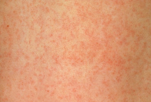 adult rash