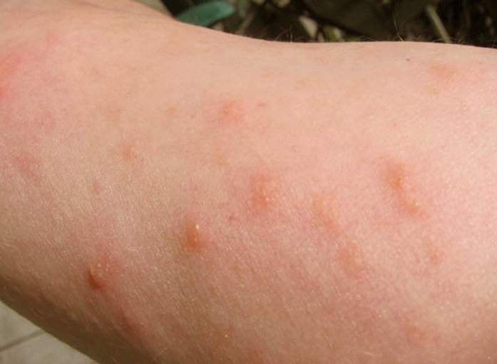 poison ivy rashes pictures