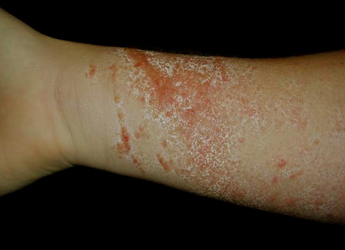 Poison Oak Rash Pictures Symptoms Causes Treatment,Hot Water Heater Repair Near Me