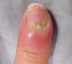 Hangnail Infection | Good Health