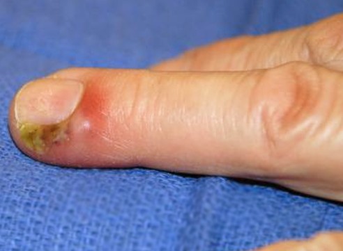 infected hangnail pictures