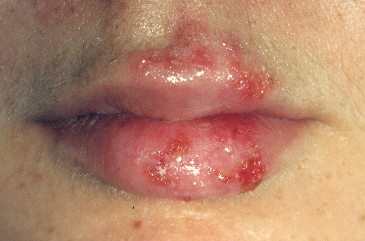 sores on lips pictures 2