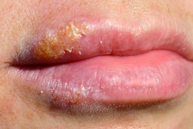 sores on lips pictures